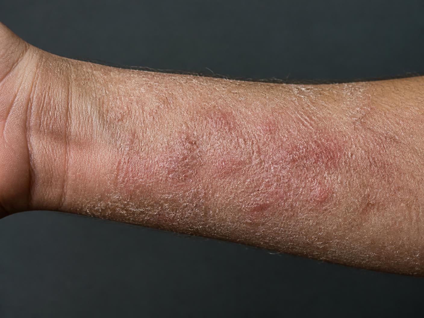 Reference photograph of a forearm with dry, rough, reddened skin